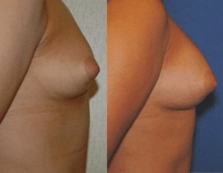 Before and after breast augmentation using fat grafting