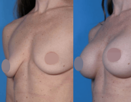Breast implants before and after