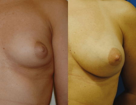 Breast Augmentation with Fat Grafting, before and after