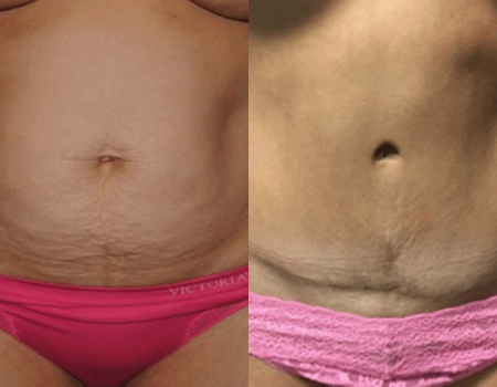 DC Tummy Tuck Procedure, before and after