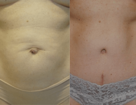 Tummy Tuck DC, before and after