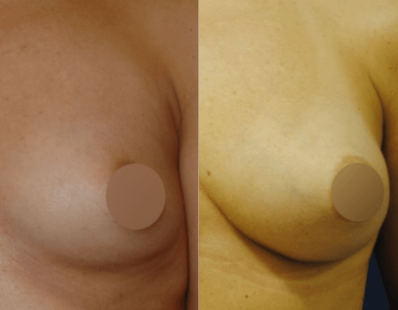 Example of Fat Grafting Breast Augmentation DC