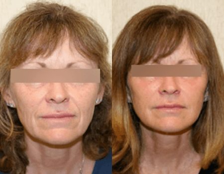 facelift, DC, before and after