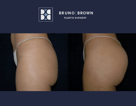 A before and after of a Brazilian Butt Lift