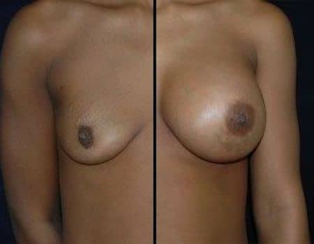 DC Breast implants