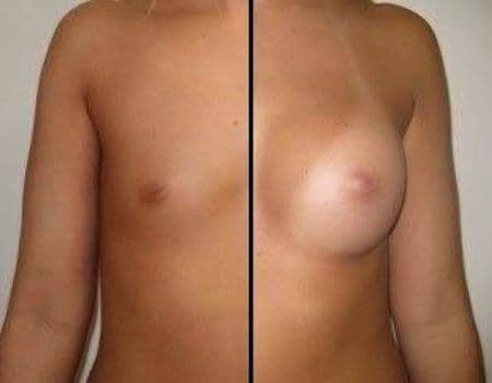 Breast Implants in Bethesda, MD