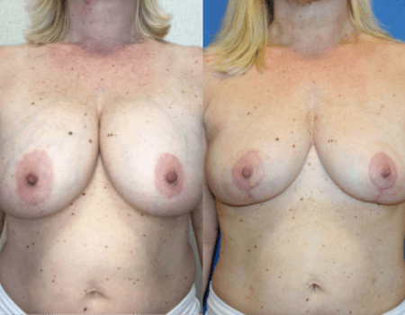 Breast Reduction