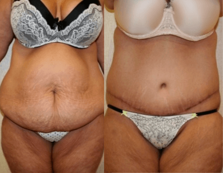 plus size tummy tuck consultation