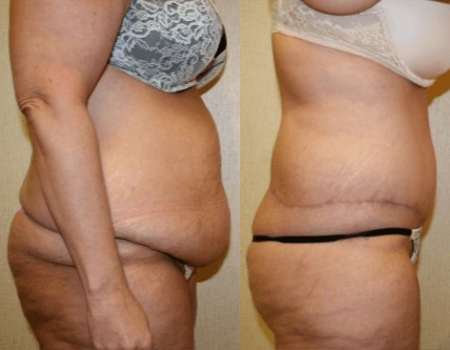 Tummy Tuck DC