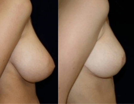 DC Breast Reduction