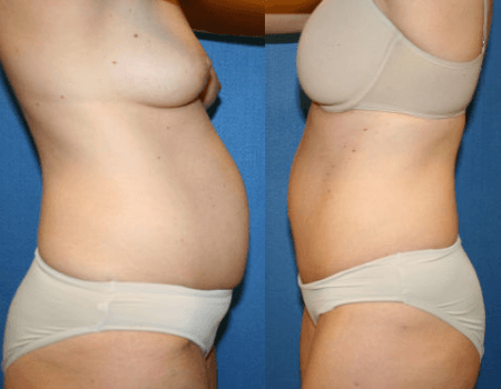 Top Plastic Surgery Procedures: Tummy Tuck - Bruno