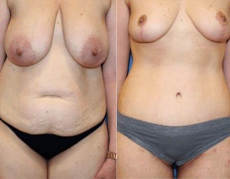 EPIC BREAST REDUCTION TRANSFORMATION!!!, DDD TO B