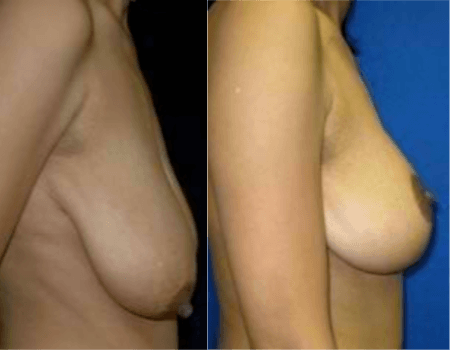 Breast Lift in DC