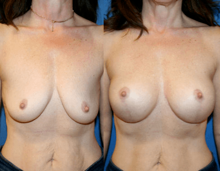 Washington DC Breast Lift