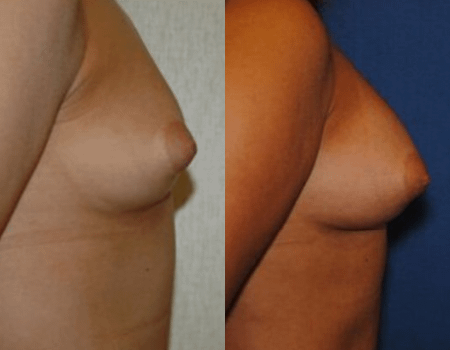 Fat Grafting Breast Augmentation DC
