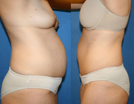 DC Tummy Tuck, before and after