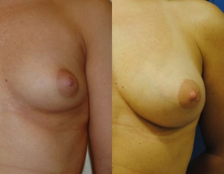 Breast Augmentation with Fat Grafting, before and after
