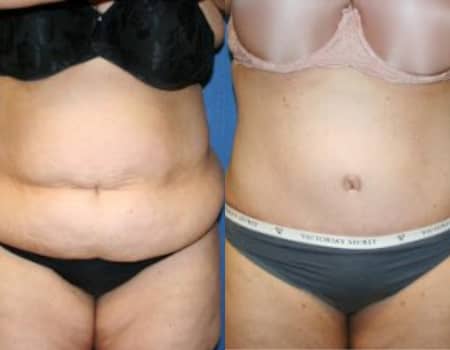 Tummy Tuck DC