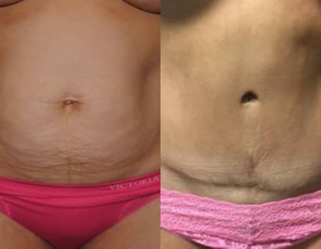 4 Tips for a Smooth Tummy Tuck Recovery