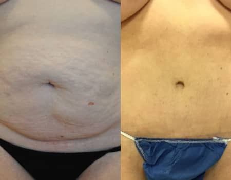 Pin by Stacy Guerra on Mommy's Makeover  Mommy makeover surgery, Tummy  tucks recovery, Tummy tucks