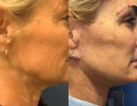 Facelift, Before and After from Top Northern Virginia Plastic Surgeons