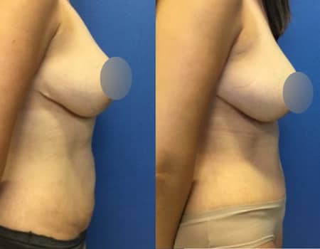 Tummy Tuck DC, before and after