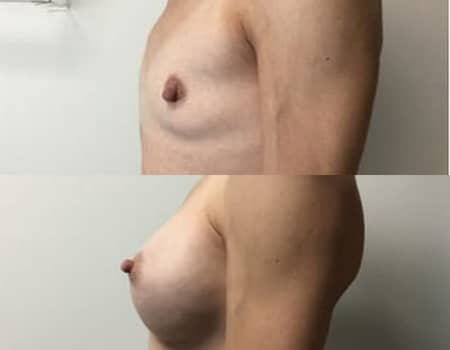 A before and after breast augmentation surgery 