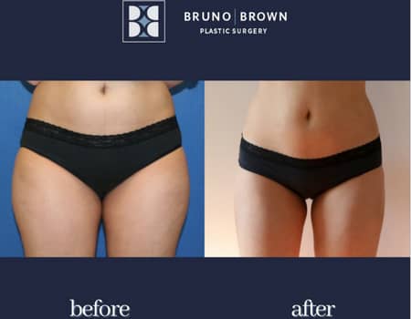 before and after abdomen liposuction surgery