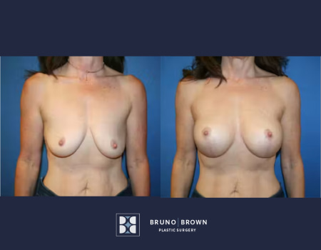 before and after breast augmentation of a middle age women