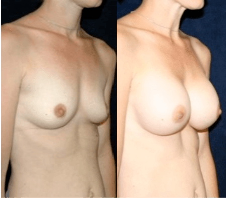 Breast Augmentation in DC