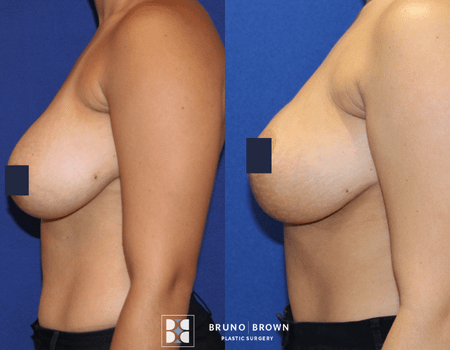 Breast Augmentation before and after side view