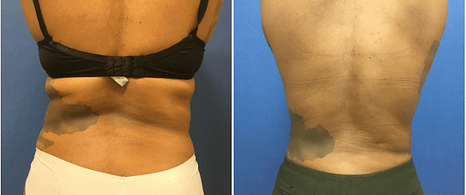 Liposuction Chevy Chase Before and After Back