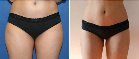 Liposuction Chevy Chase Before and After Stomach