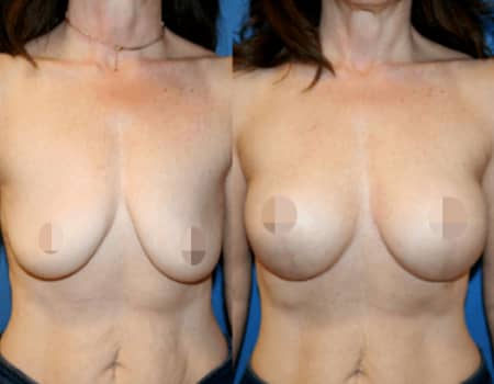 Breast Lift, DC Plastic Surgeons