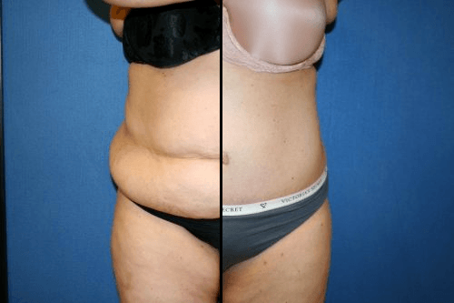 Washington DC Top Tummy Tuck Before and After