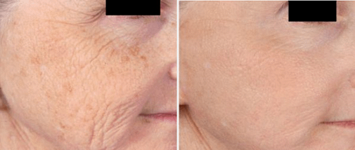 Microneedling B and A