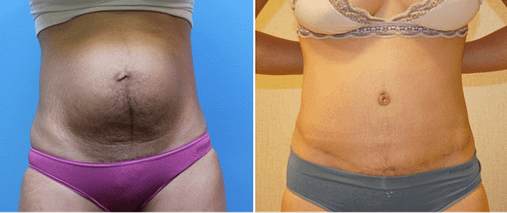 DC Tummy Tuck Before and After