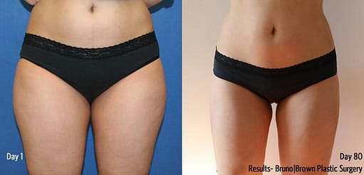 Liposuction results - before and after from day 1 to day 80