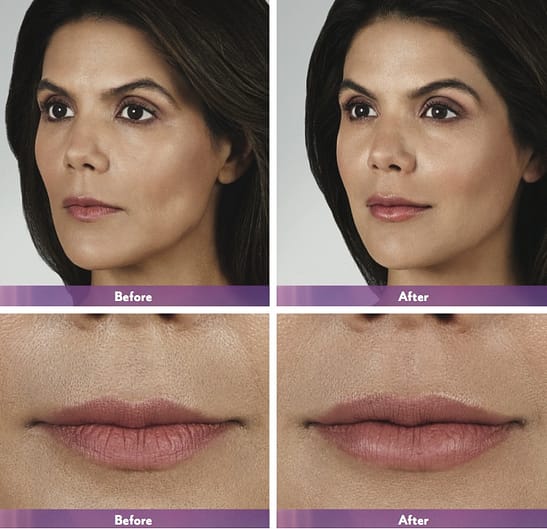 Botox and Juvederm