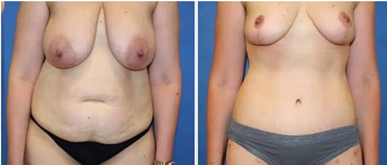 Mommy Makeover: Tummy Tuck - Regain Your Pre-Baby Figure