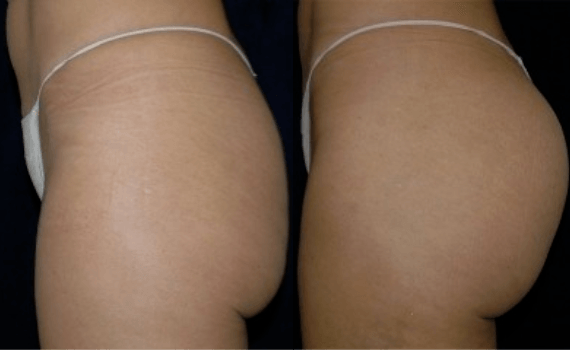 Brazilian Butt Lift DC