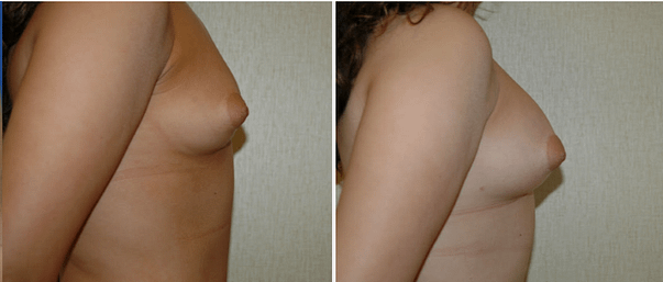 DC Fat Grafting Breast Augmentation, before and after