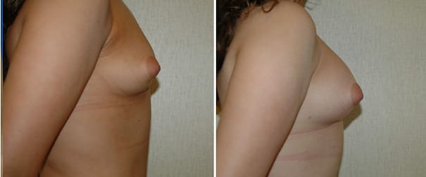 Fat Grafting Breast Augmentation, DC