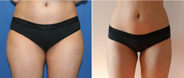 Results of Liposuction DC