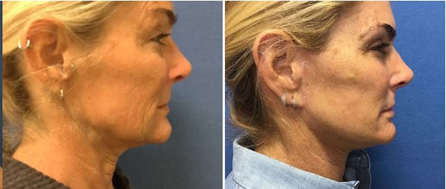 DC Facelift, before and after