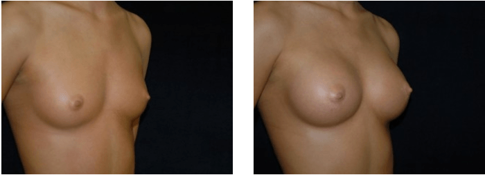 Breast Augmentation DC Before and After