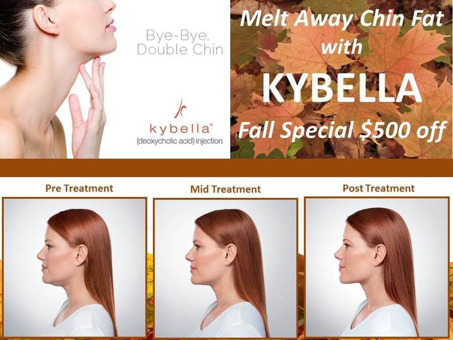 Kybella DC Offer Plastic Surgeons Office