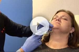 Kybella Injection (Double-Chin Reduction) Northern Virginia