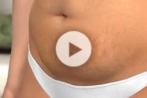 Washington DC Tummy Tuck Northern Virginia