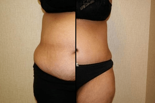 Tummy Tuck, Abdominoplasty, Body Contouring